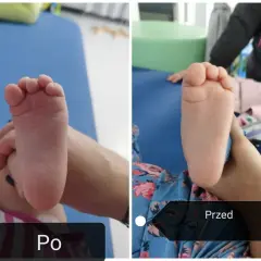 Dwa zdjęcia stopy dziecka: po lewej stopa sierpowata, po prawej ta sama stopa po terapii.