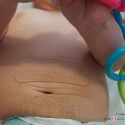Brzuszek niemowlaka z plastrami na przepuklinę pępkową. Dziecko bawi się kolorową zabawką.