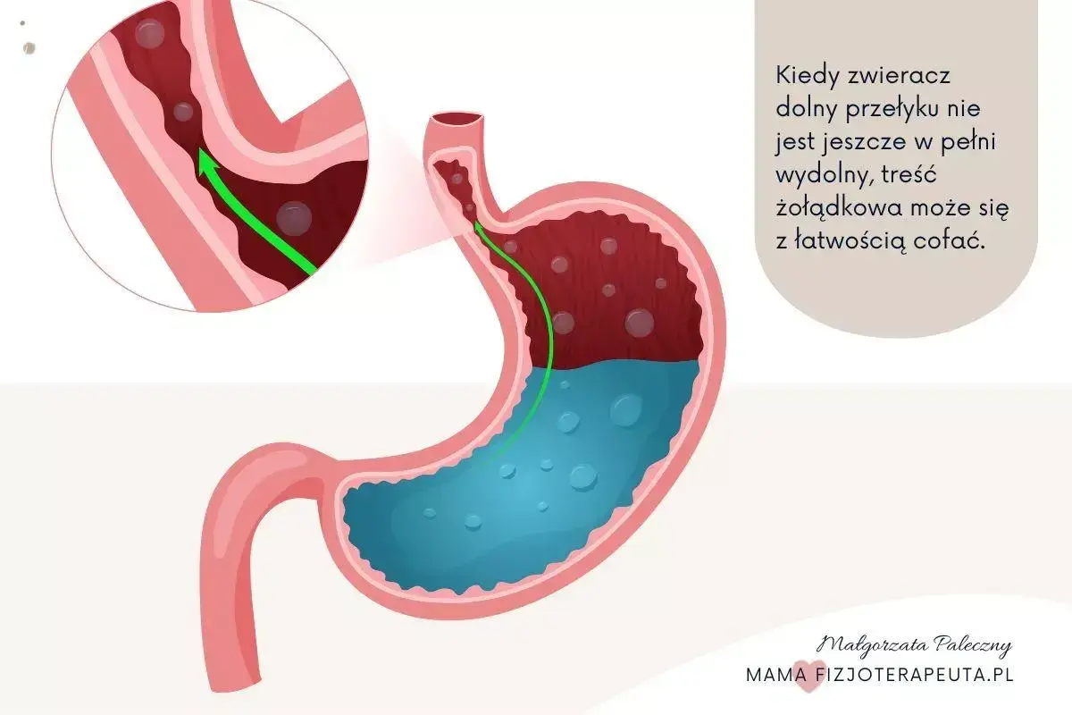 Ilustracja pokazuje cofanie się treści żołądkowej do przełyku, co jest typowe dla refluksu u niemowlaka.