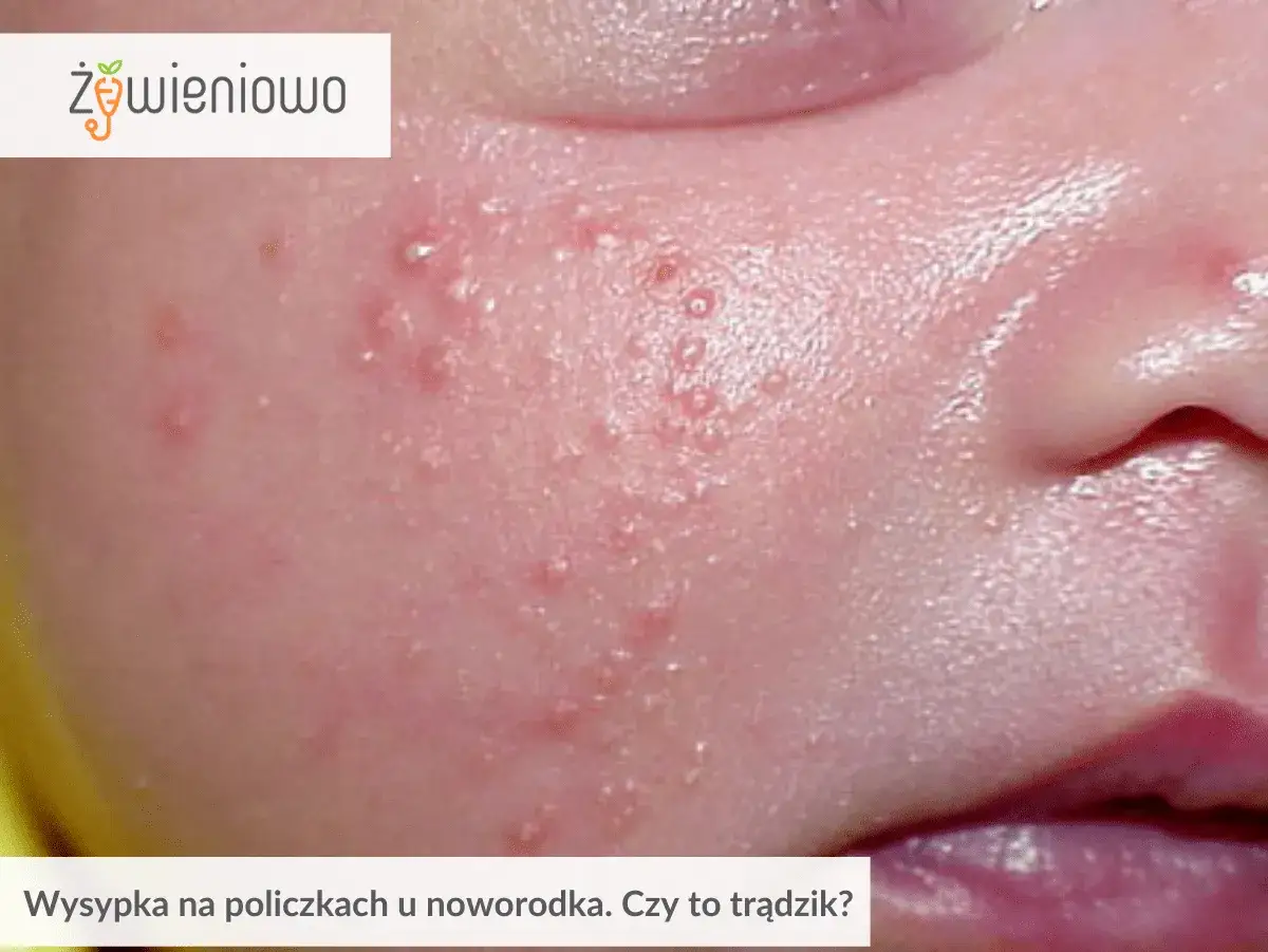 Skóra niemowlaka z małymi białymi krostkami na policzkach, przypominającymi trądzik.