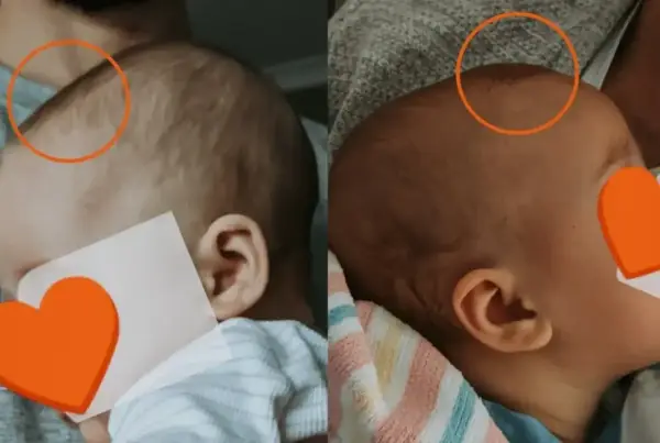 Dwa ujęcia główki niemowlaka, pokazujące jak zarasta ciemiączko. Na obu zdjęciach widoczne są pomarańczowe kółka zaznaczające obszar ciemiączka.