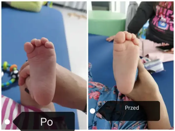 Dwa zdjęcia stopy dziecka: po lewej stopa sierpowata, po prawej ta sama stopa po terapii.
